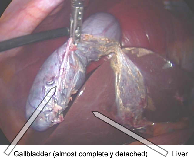 gallbladder location in body. Gallbladder Problems in